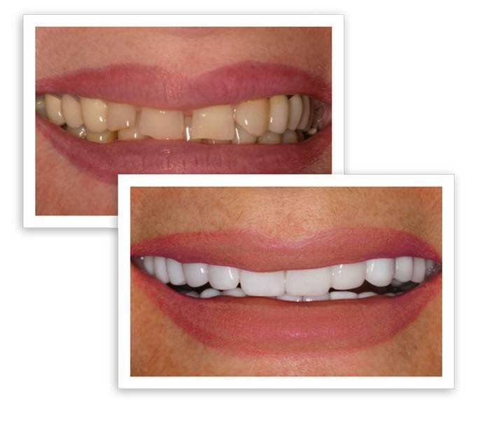 Dental Veneers