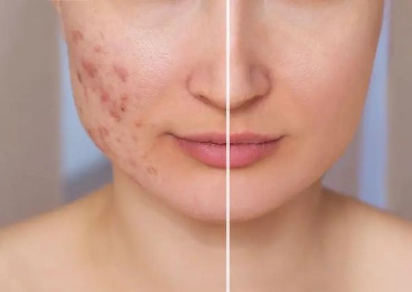 Acne-scar-treatment-in-dwarka