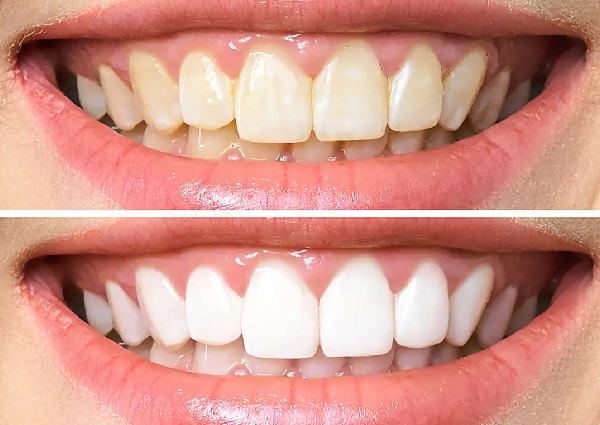 teeth-whitening-in-Delhi