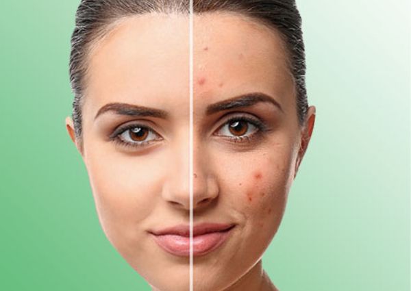 acne-scar-treatment-in-dwarka