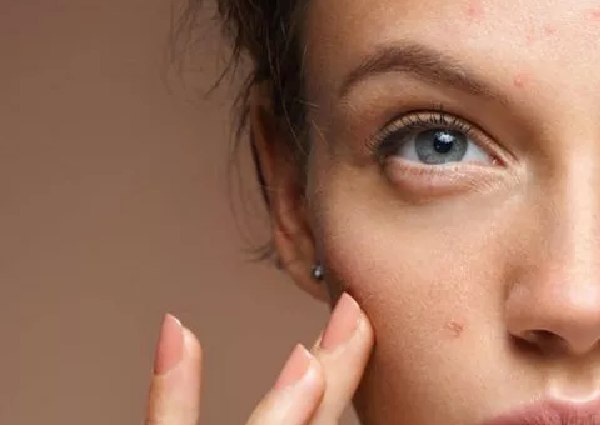 mole-or-warts-skin-treatment