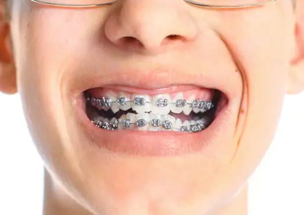 best-braces-treatment-clinic