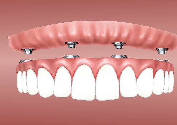 best-dental-implants-clinic