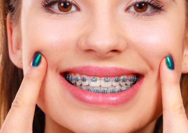 braces-treatment-Delhi