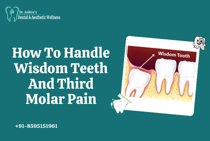 How To Handle Wisdom Teeth And Third Molar Pain