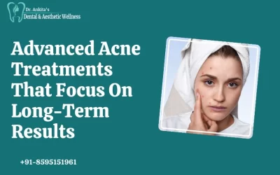Advanced Acne Treatments That Focus On Long-Term Results