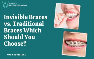 Invisible Braces vs. Traditional Braces: Which Should You Choose?