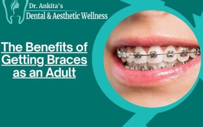 The Benefits of Getting Braces as an Adult