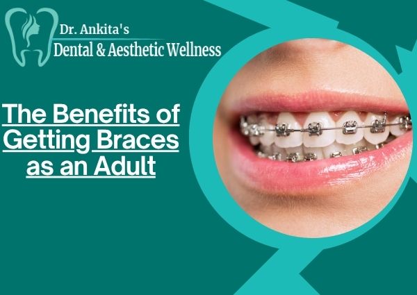 The Benefits of Getting Braces as an Adult