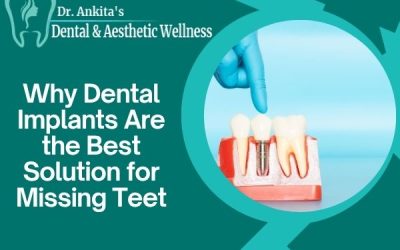Why Dental Implants Are the Best Solution for Missing Teet